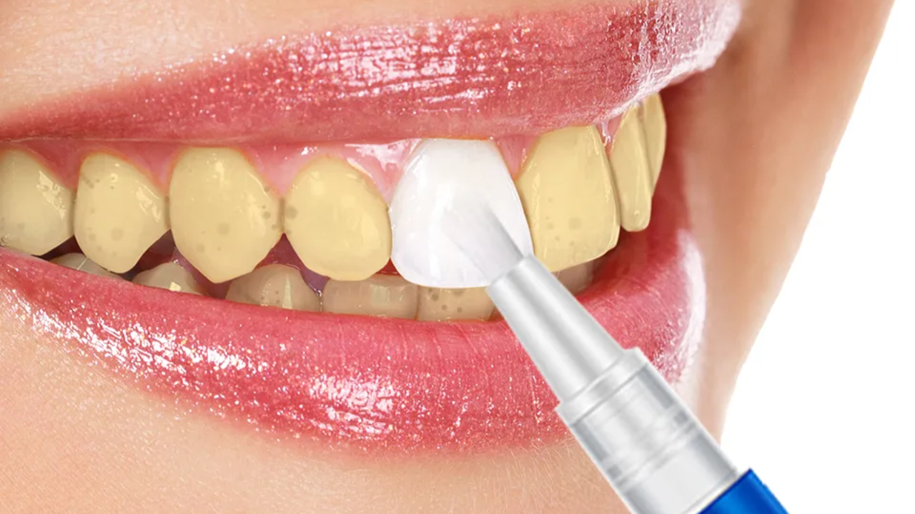 تبييض الأسنان في المنزل: بمكون ميخطرش على بالك وفي 5 دقائق النتيجة أسنان لامعة وبراقة