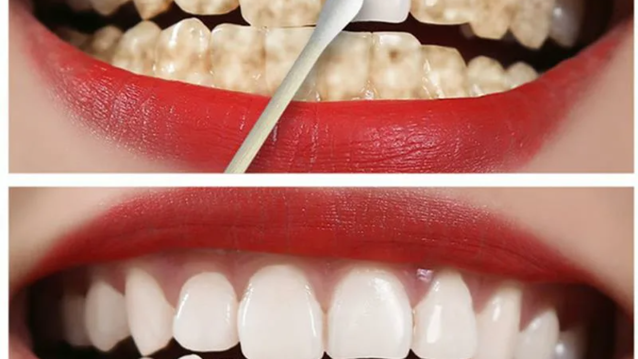تبييض الأسنان في المنزل: أوعي ترميه تاني وعالجي اصفرار أسنانك في 10 دقائق