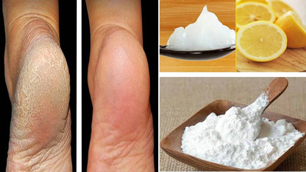 أفضل وصفة لتنعيم الكعبين والتخلص من التشققات بمكونات طبيعية من مطبخك